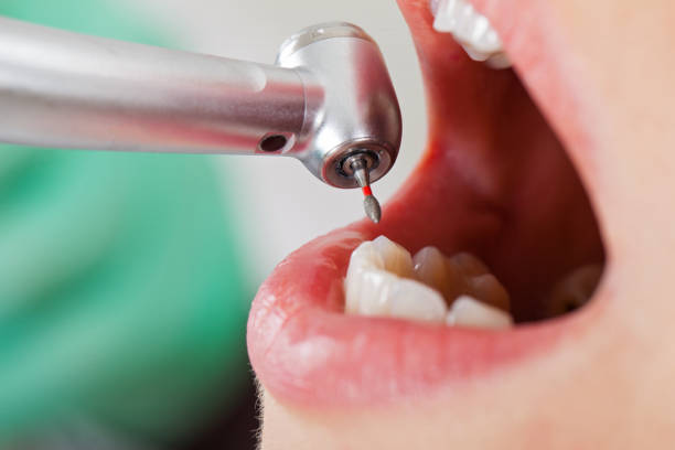 Best Knocked-Out Tooth (Avulsed Tooth) Treatment in Valley Falls, KS